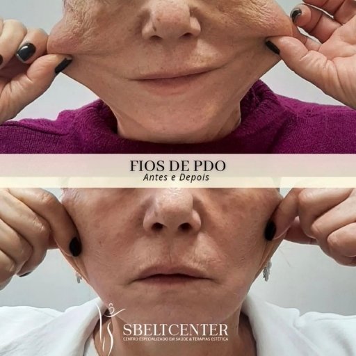 Bioestimuladores de Colágeno (2)