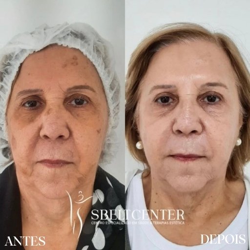 Bioestimuladores de Colágeno (4)