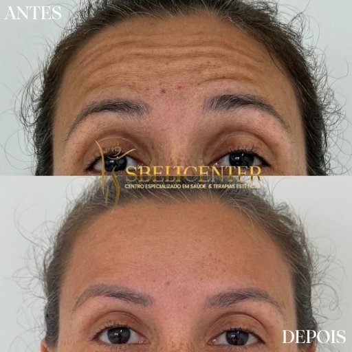 Botox (10)