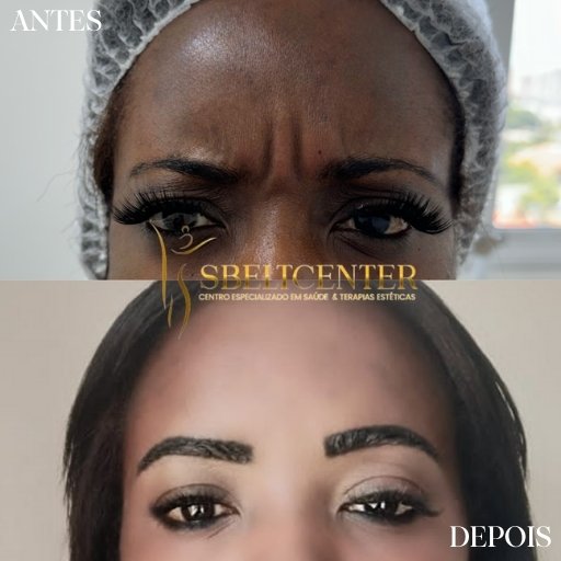 Botox (11)