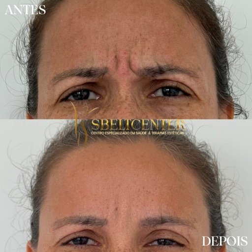 Botox (12)