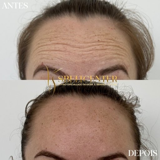 Botox (13)