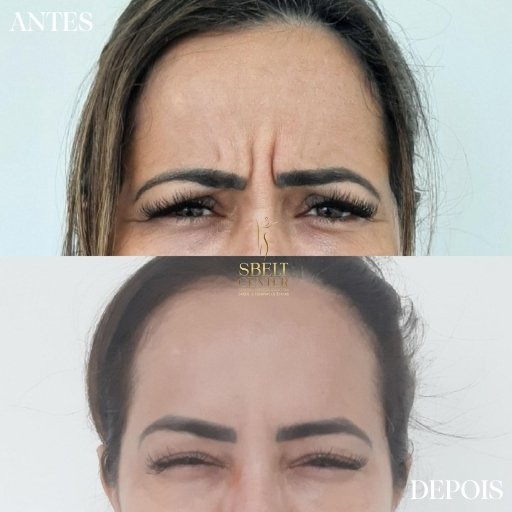 Botox (15)