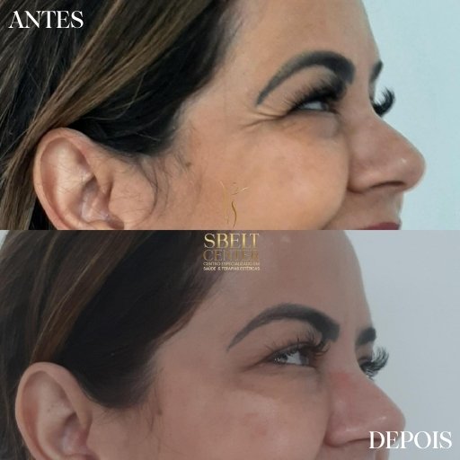 Botox (16)
