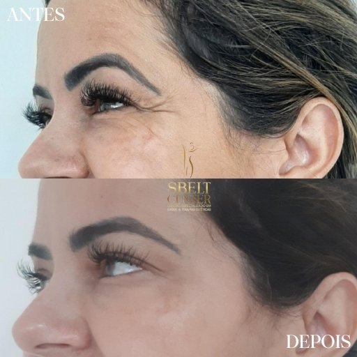 Botox (17)