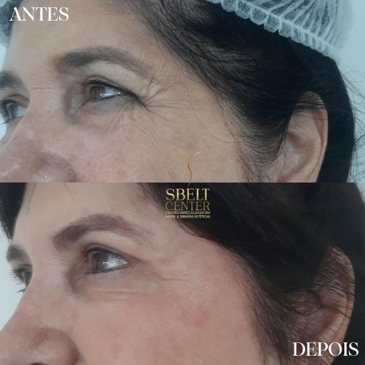 Botox (18)