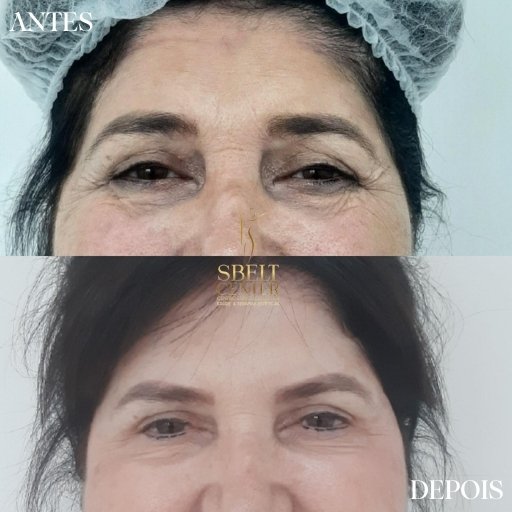 Botox (19)
