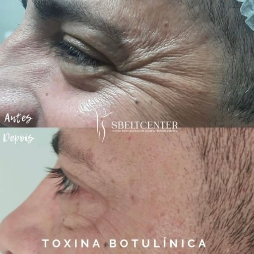 Botox (2)