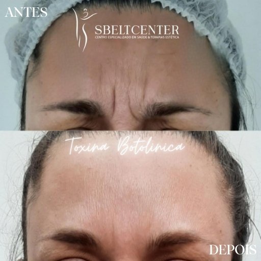 Botox (20)