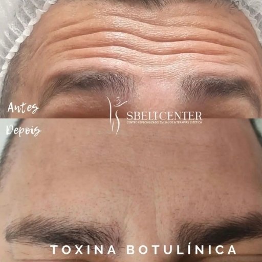 Botox (3)