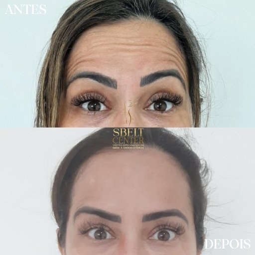 Botox (4)