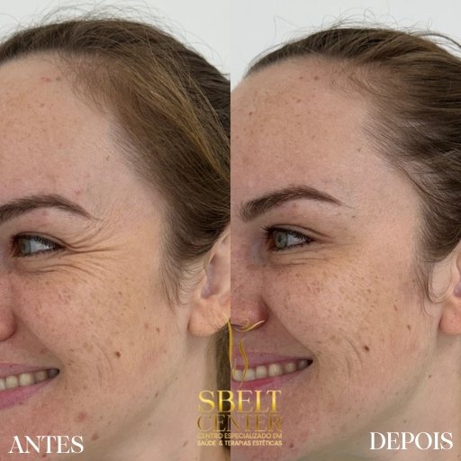 Botox (5)