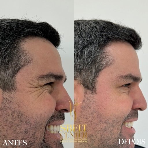 Botox (6)