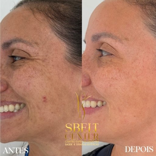 Botox (7)
