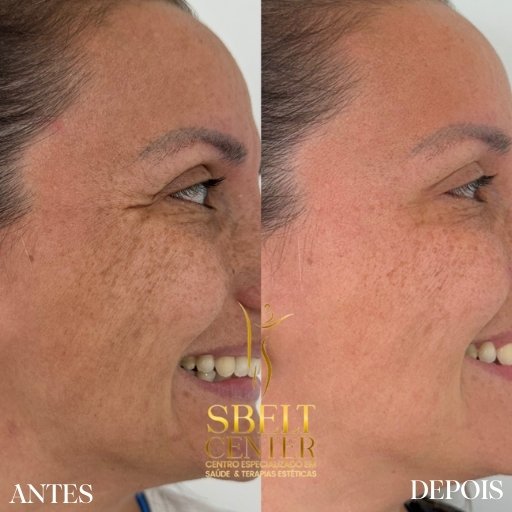 Botox (8)