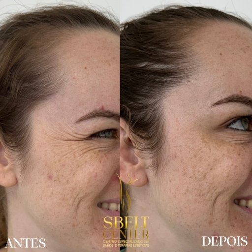 Botox (9)