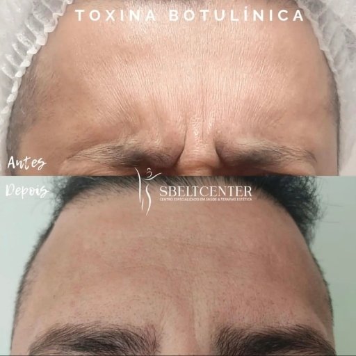 Botox