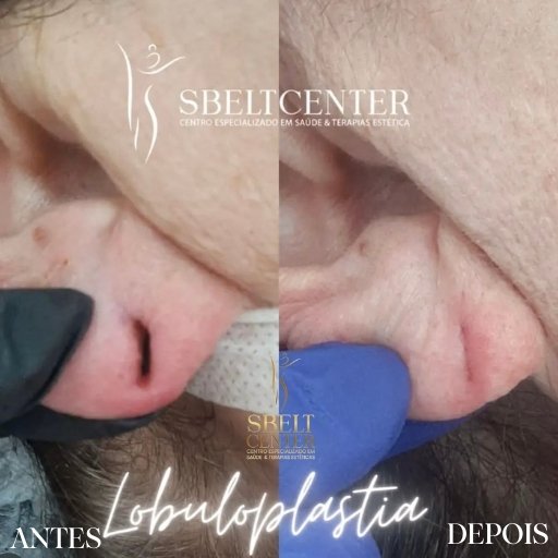 Lobuloplastia (2)