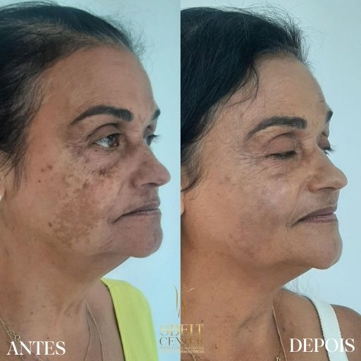 Melasma (2)