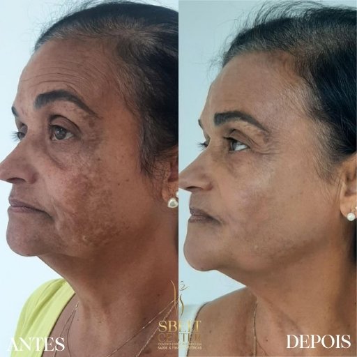 Melasma (3)