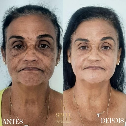 Melasma